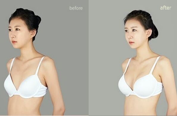pred a po plastickej augmentácii prsníkov
