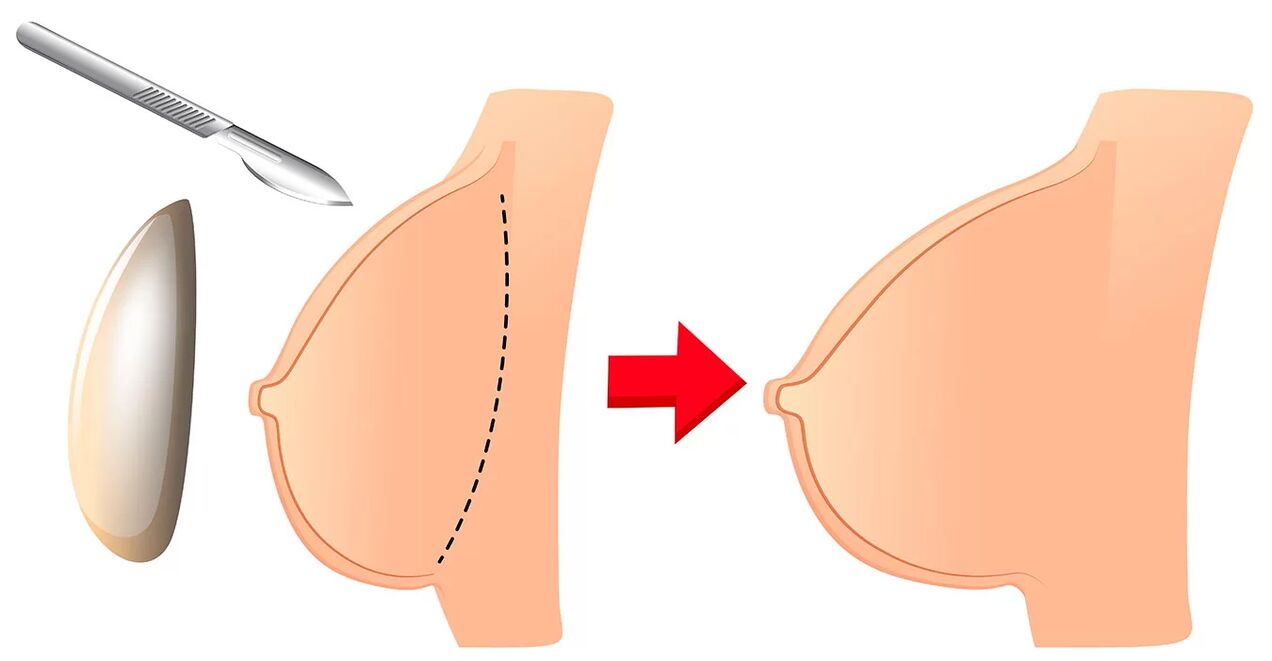 Zväčšenie prsníkov pomocou implantátu